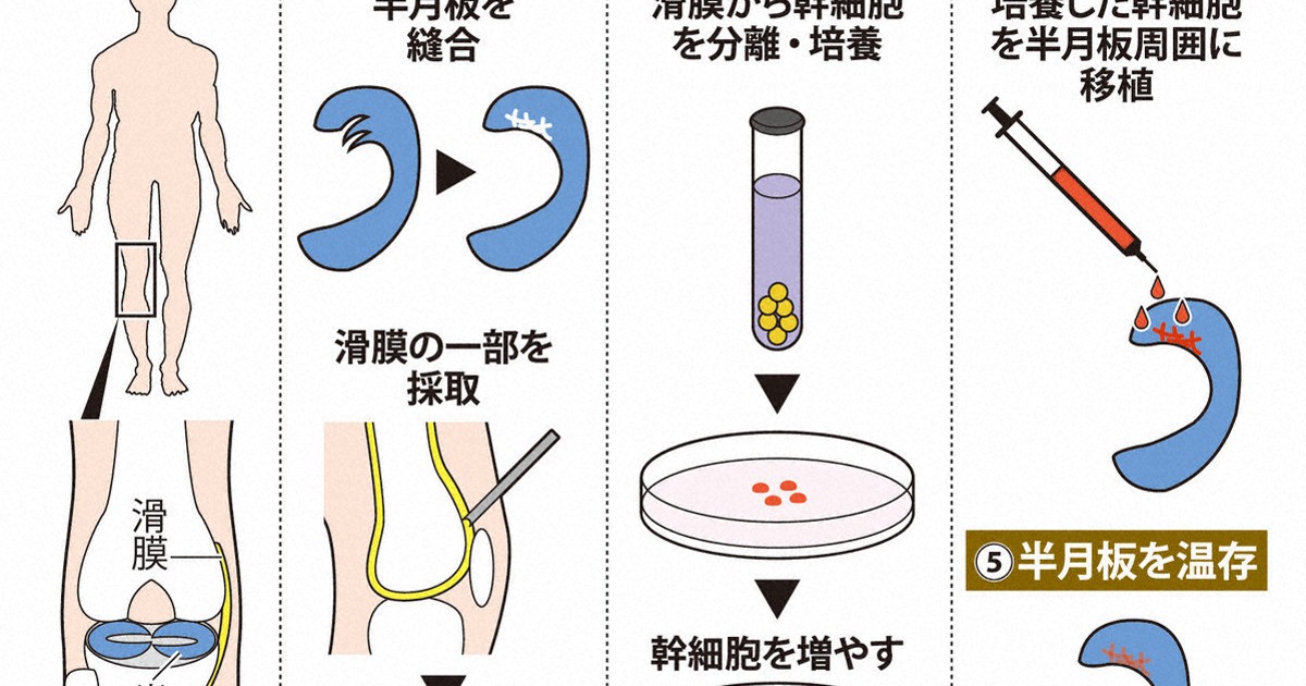 国内初、半月板の再生医療等製品 温存が可能、新たな選択肢に | 毎日新聞
