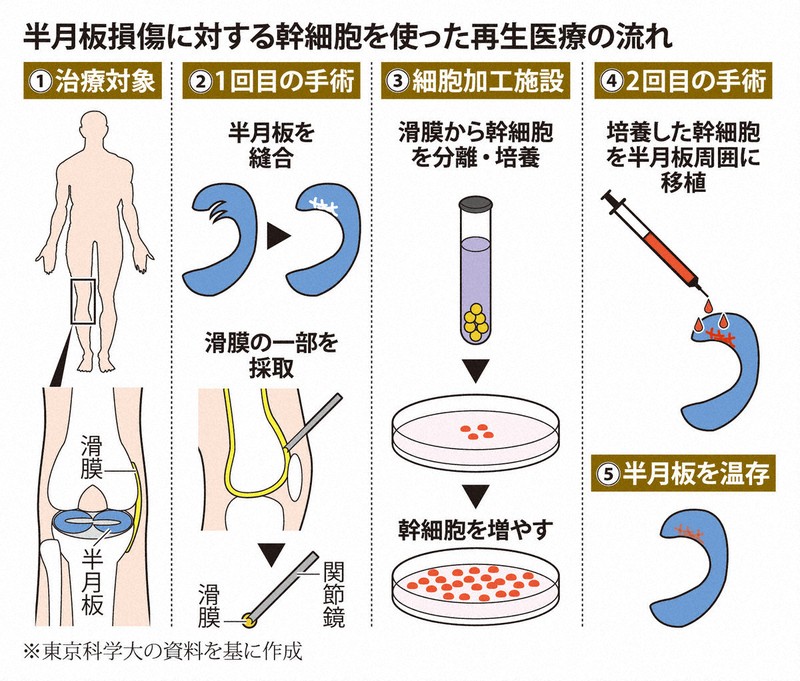 国内初、半月板の再生医療等製品 温存が可能、新たな選択肢に | 毎日新聞