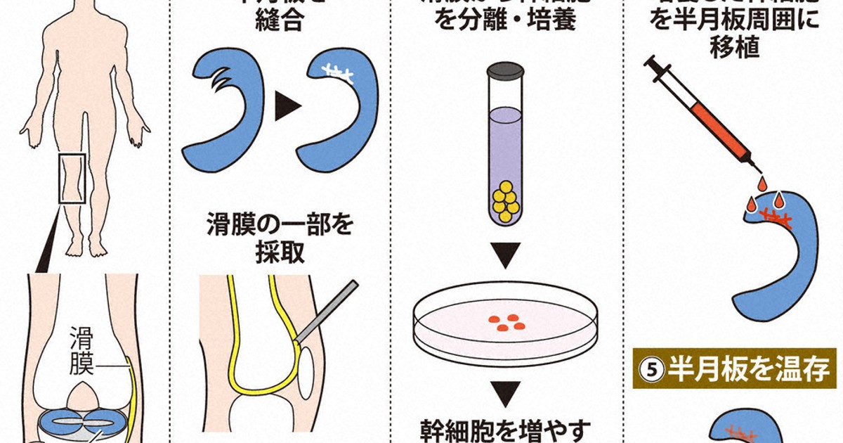 くらしナビ・医療：損傷した半月板 切除せず再生 | 毎日新聞