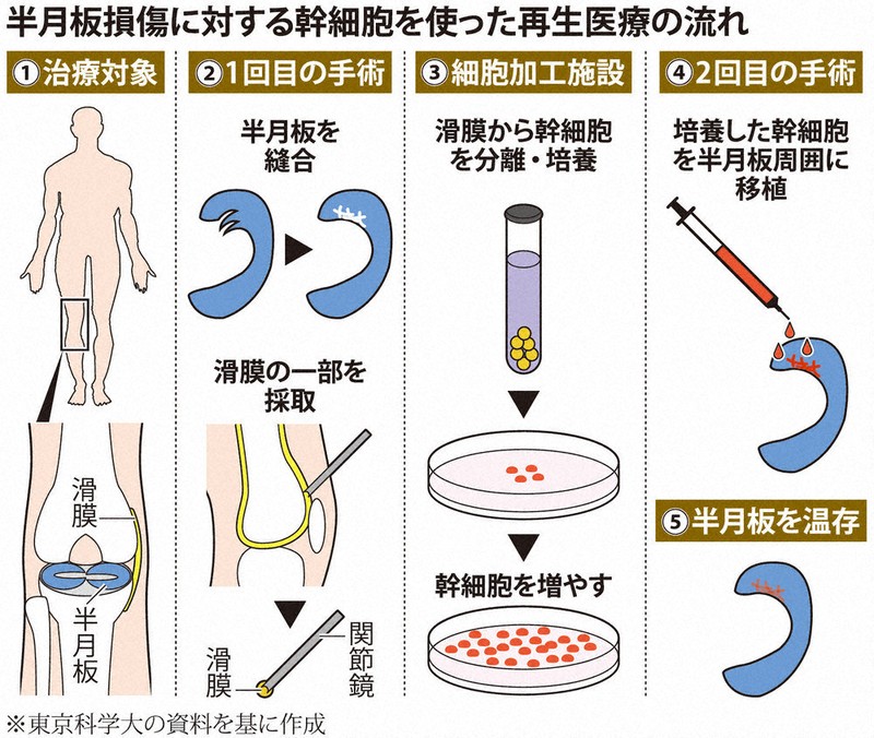 くらしナビ・医療：損傷した半月板 切除せず再生 | 毎日新聞