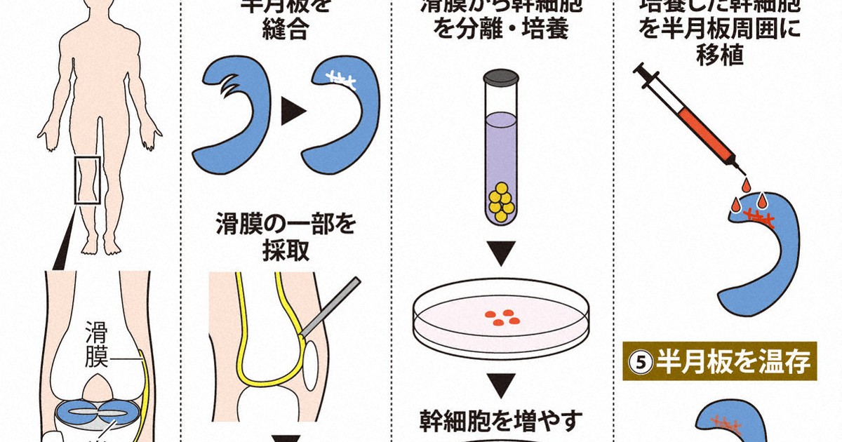 損傷した半月板、切除せず再生 | 1分ニュースzukai | 毎日新聞