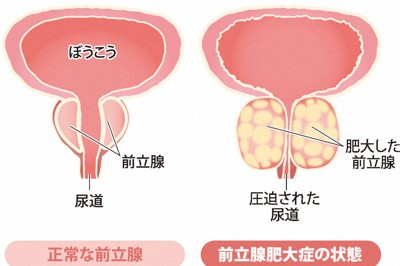 前立腺肥大症　日帰り手術も