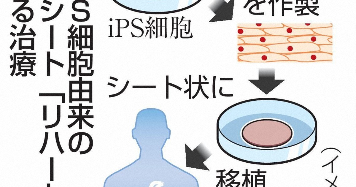 iPS細胞心肌貼片納入健保給付 心衰竭治療迎新里程碑