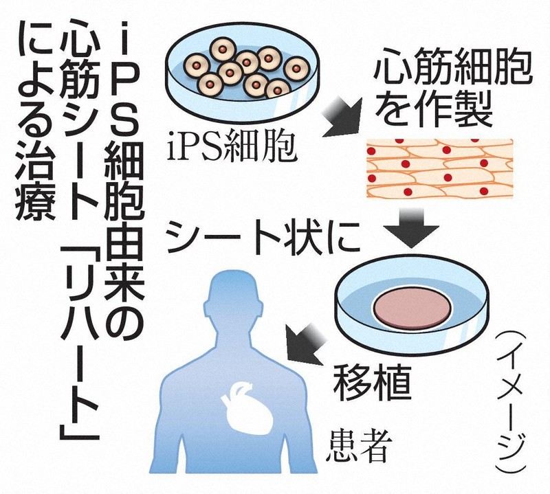 iPS細胞心肌貼片納入健保給付 心衰竭治療迎新里程碑